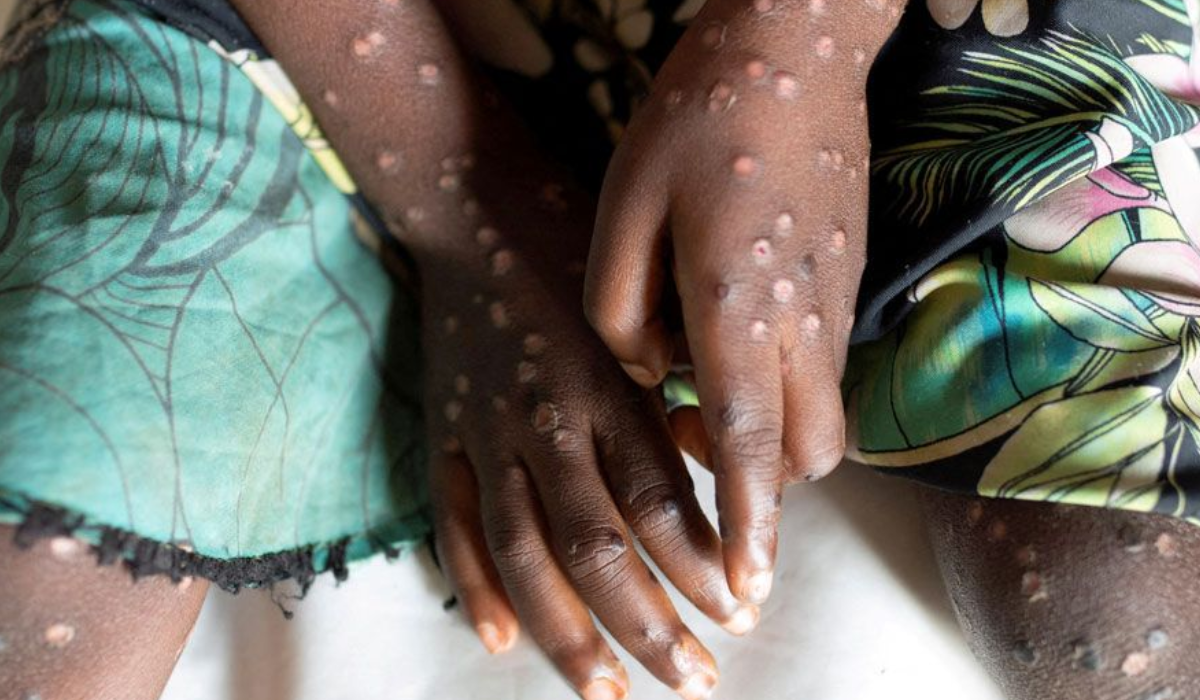 Mpox : Africa CDC Declares Mpox a Public Health Emergency Amid Alarming Spread